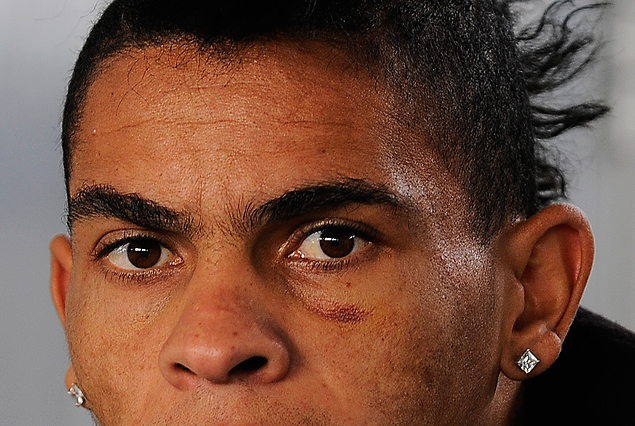 Jonathan Alvez con la huella del derrame en el ojo izquierdo y la lesión que lo excluyó de la definición del Campeonato Uruguayo.