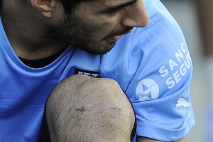 Las cicatrices en la rodilla derecha de Luis Suárez.