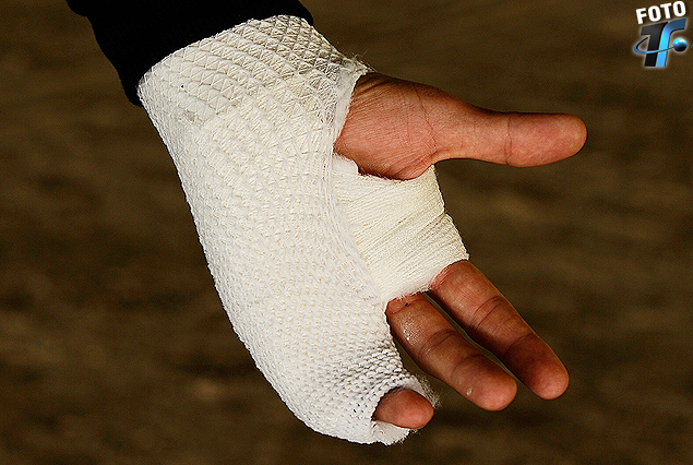 El delantero fue enyesado el viernes para inmovilizar la mano. 